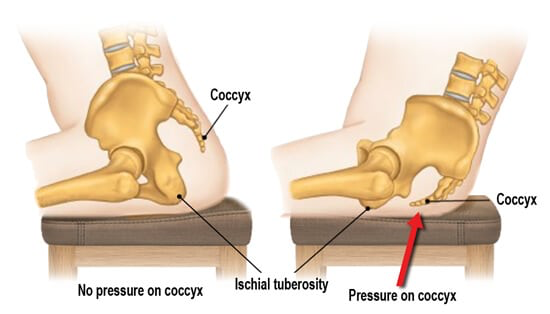 Alternating Pressure Coccyx Cushion - No More Tailbone Sores