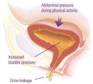 Stress Urinary Incontinence? Pelvic Floor Physiotherapy can Help